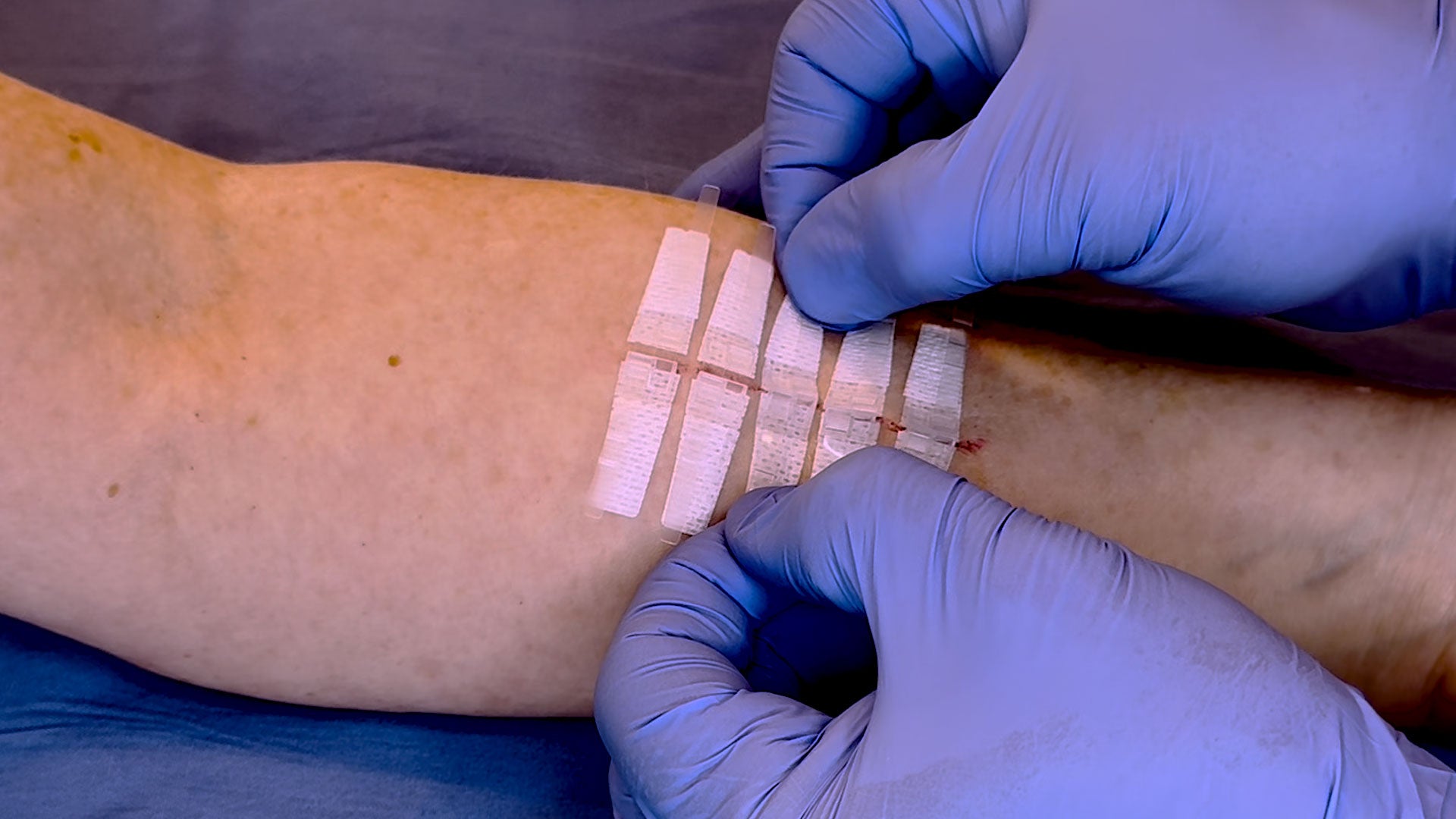 Load video: DermaClip Skin Closure — Application Simulation. Eversion of skin edges on locking.