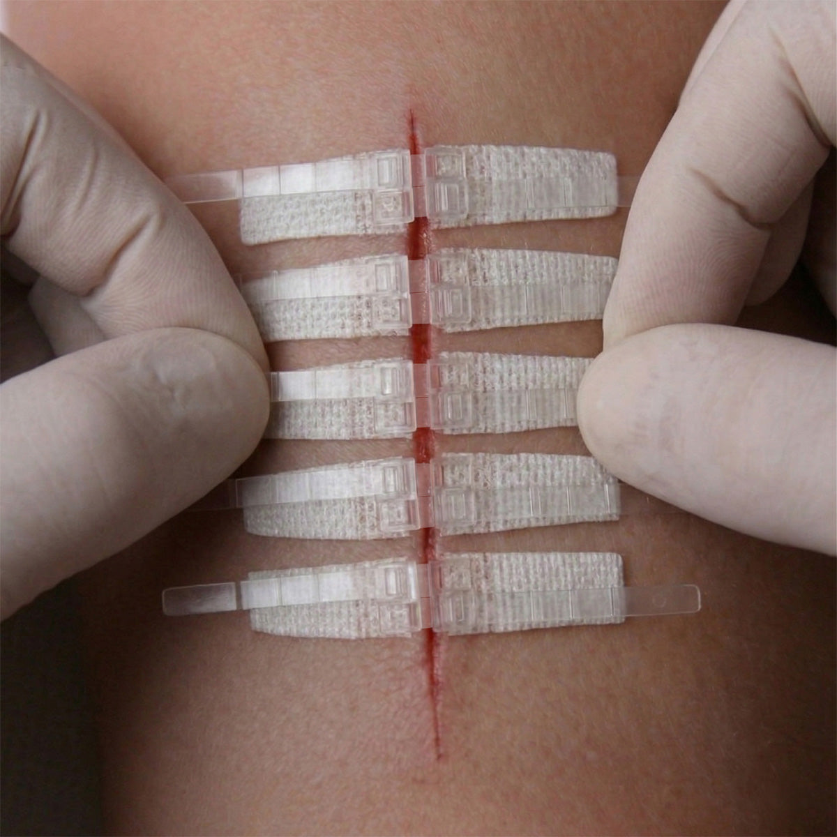 DermaClip Regular applied to wound — 5-clip needle-free skin closure in clinical use