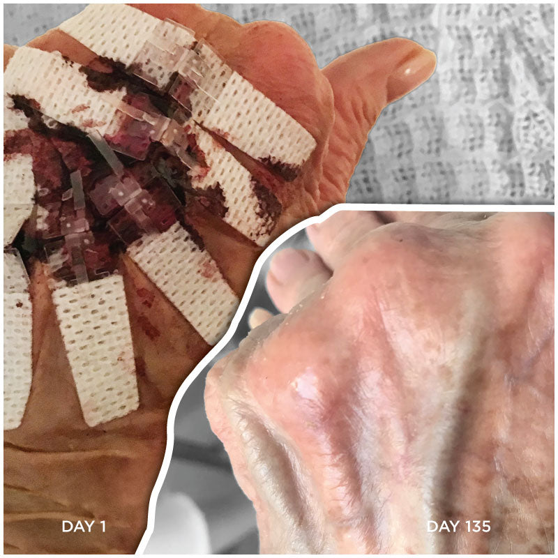 DermaClip Skin Closure Device | Needle-Free Wound Closure w/ Eversion