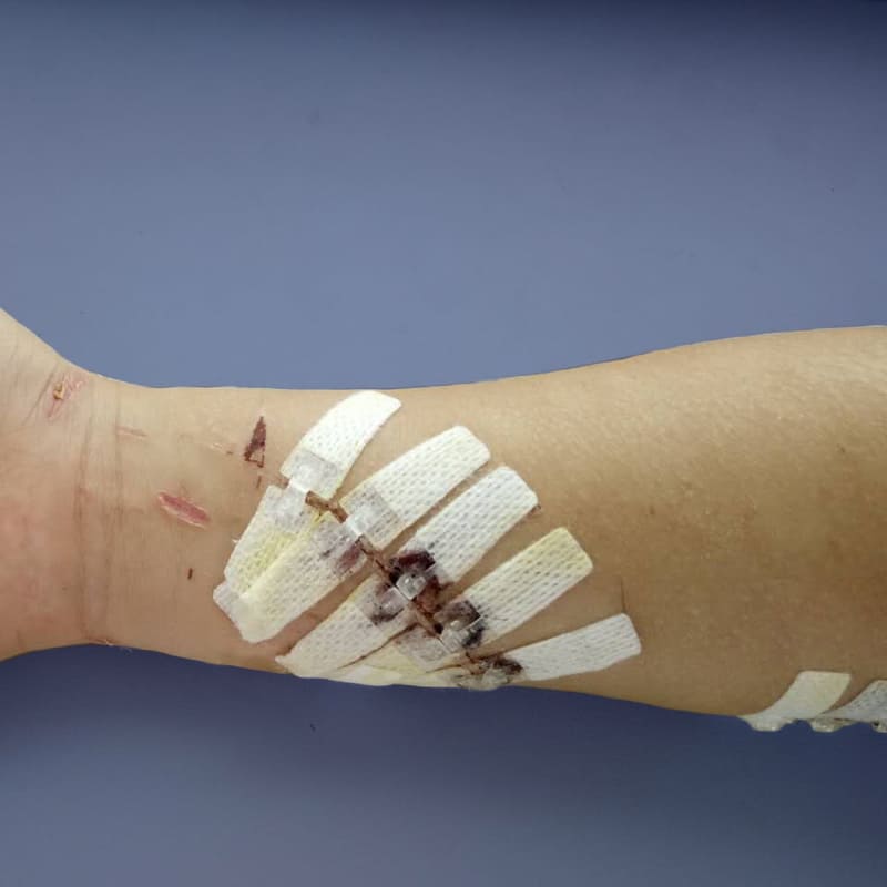 DermaClip on Traumatic Arm Laceration